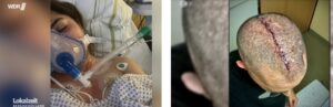 17-Jährige hat 15 Operationen hinter sich und nimmt 40 Tabletten täglich nach BioNTech Spritze – RA Pülz ist auf einem Auge blind